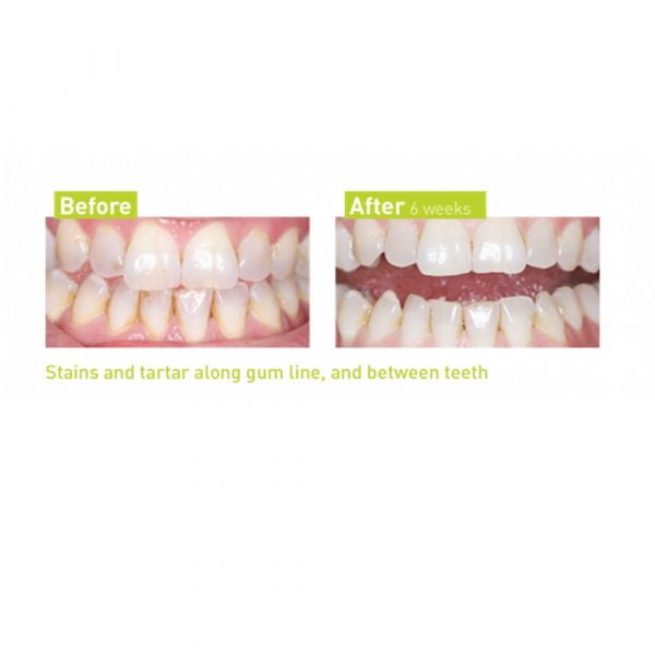 סילקן טות'וייב - מברשת שיניים חשמלית היחידה המסירה אבנית לפני ואחרי